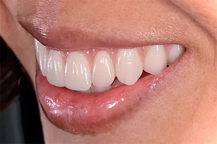 dentadura fixa e Implante detario